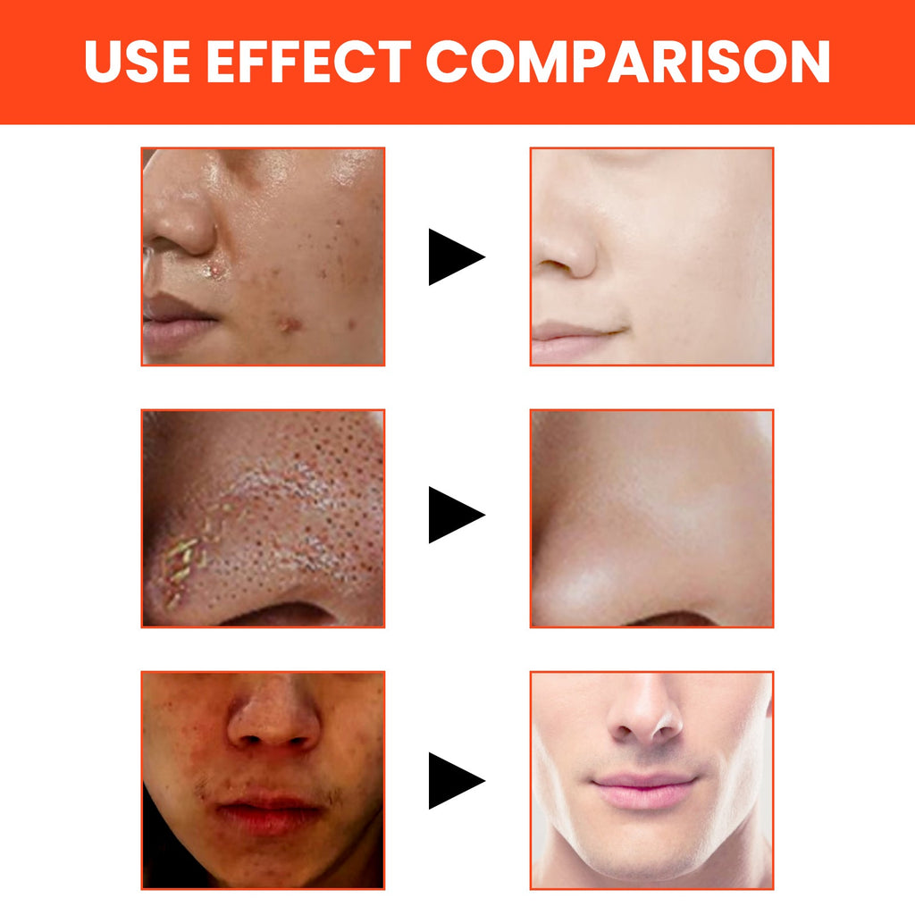 Men's Volcanic Face Wash, Acne Blackhead Face Deep Clean Pores And Oil Control