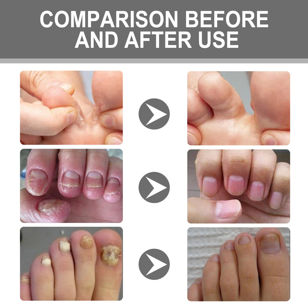 Nail Care Cream, Light Armor Repair Bad Ingrown Nail Nails Brothers Nail Thickening A Ditch Nursing