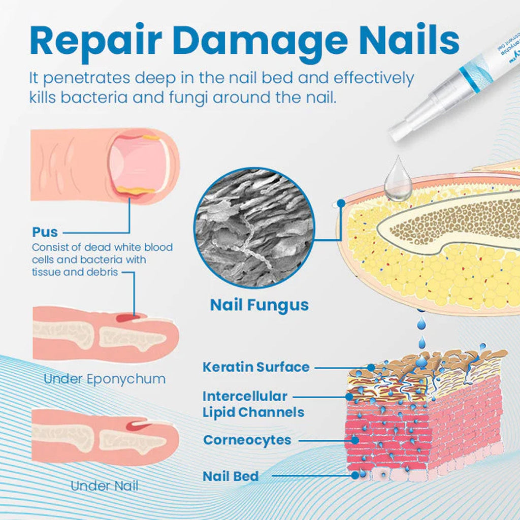 Anti-Paronychia Nail Repairing Gel, Repair Encased Rotten Nails Soft Nails Thickening Pain Relief Cleansing Care