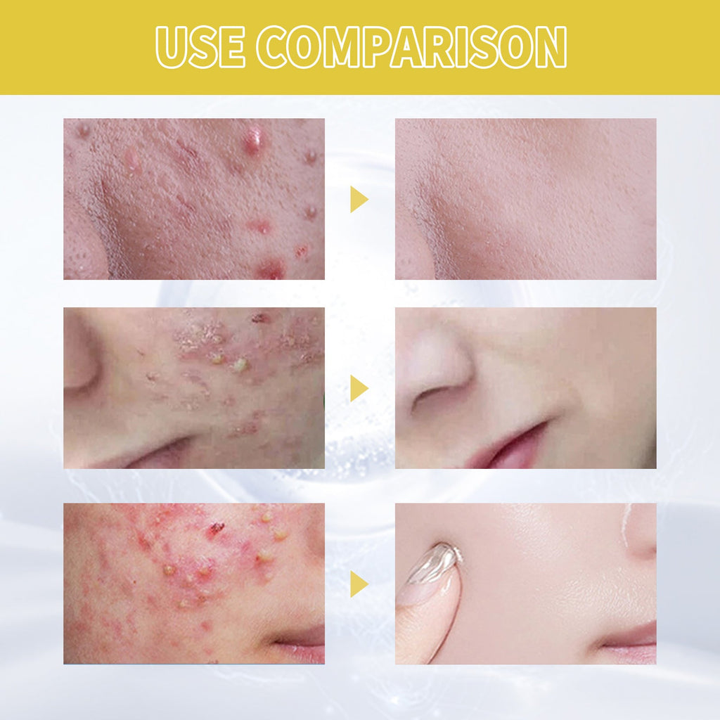 Orchid Acne Essential Oil Cleans And Brightens Pores And Hydrates Facial Care Essence